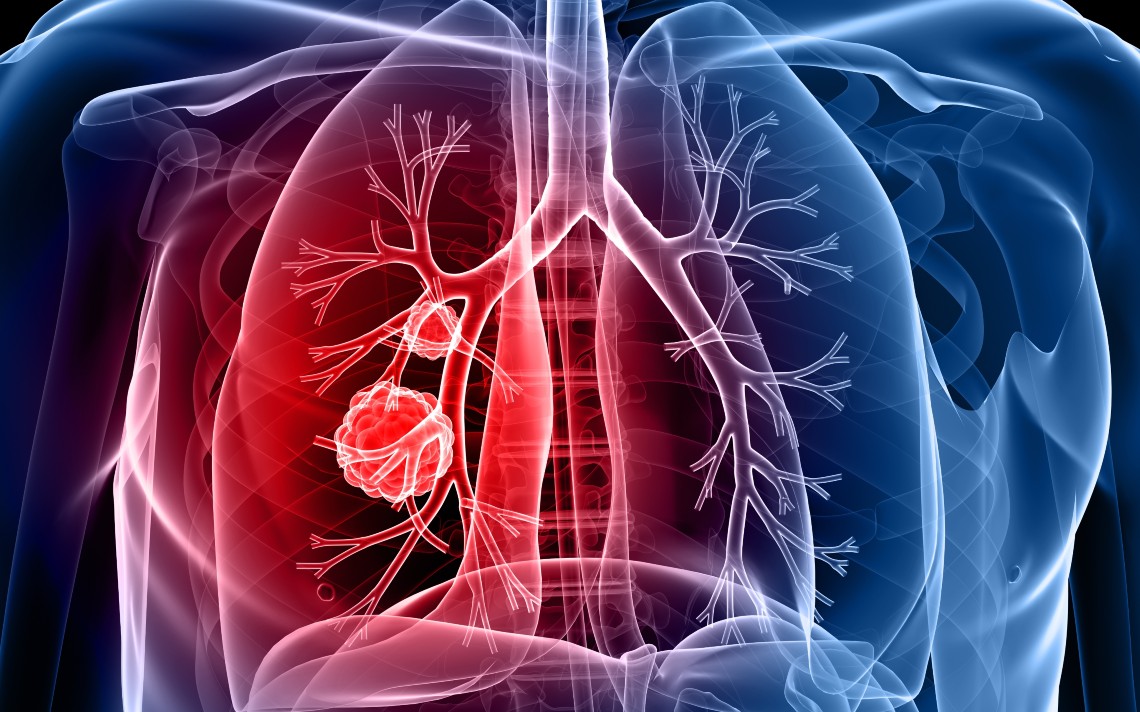 Lung Cancer Blog